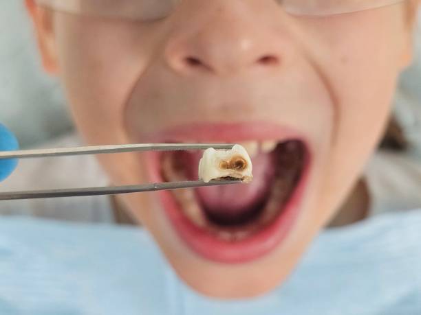 Best Broken or Cracked Tooth Emergency Dentist in Ithaca, MI